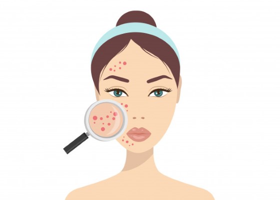 Defekty kože sú skutočne širokým témou, ktorá zahŕňa najrôznejšie typy dermatitídy, psoriázu, pehy, ale tiež napríklad akné